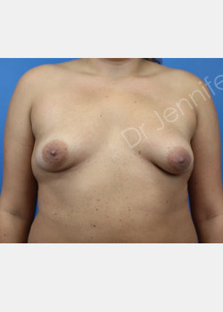 Bilateral Breast Augmentation Suction- assisted Lipectomy of Bilateral Axillae & Lateral Chest Breast Implant