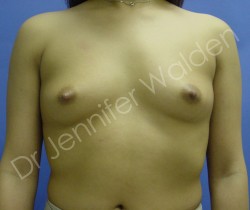 Before Image: Silicone Breast Implants - front