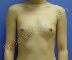 Before Image: Silicone Breast Implants - front