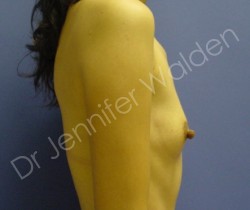 Before Image: Silicone Breast Implants - left-side