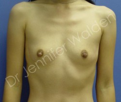 Before Image: Silicone Breast Implants - front
