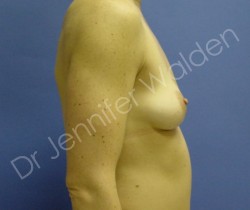 Before Image: Silicone Breast Implants - left-side
