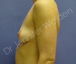 Before Image: Silicone Breast Implants - right-side