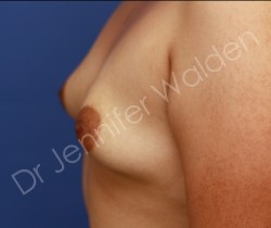 Before Image: Silicone Breast Implants - right-side