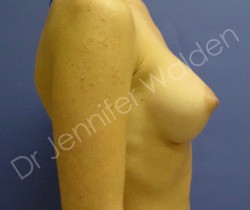 After Image: Silicone Breast Implants - left-side