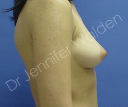 Before Image: Silicone Breast Implants - left-side