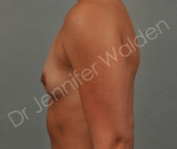 Before Image: Silicone Breast Implants - right-side