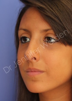 After Image: Rhinoplasty - right-front-oblique