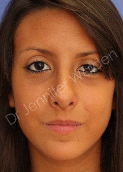 After Image: Rhinoplasty - front