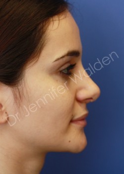 After Image: Rhinoplasty - left-side