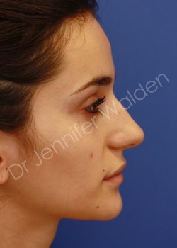 Before Image: Rhinoplasty - left-side