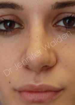 After Image: Rhinoplasty - front