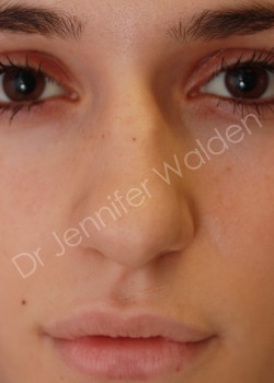 Before Image: Rhinoplasty - front