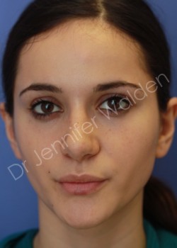 After Image: Rhinoplasty - front