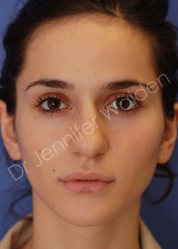 Before Image: Rhinoplasty - front