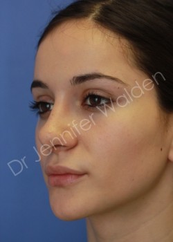 After Image: Rhinoplasty - right-front-oblique