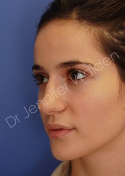 Before Image: Rhinoplasty - right-front-oblique