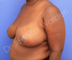 After Image: Breast Reduction - right-front-oblique