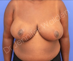 After Image: Breast Reduction - front