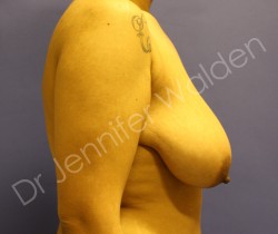 Before Image: Breast Reduction - left-side