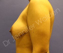 Before Image: Breast Reduction - right-side
