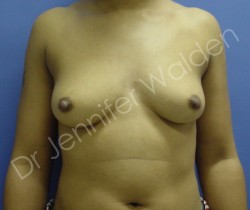 Before Image: Silicone Breast Implants - front