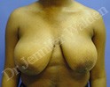 Before Image: Breast Reduction - front
