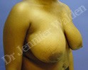 Before Image: Breast Reduction - left-front-oblique