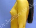 Before Image: Silicone Breast Implants - right-side