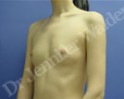 Before Image: Silicone Breast Implants - right-front-oblique