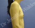 Before Image: Silicone Breast Implants - left-side