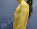 Before Image: Silicone Breast Implants - right-side