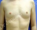 Before Image: Silicone Breast Implants - front