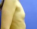 Before Image: Silicone Breast Implants - left-side