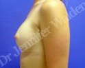 After Image: Silicone Breast Implants - right-side