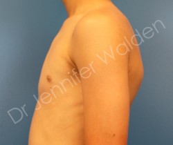 After Image: Male Breast Reduction - right-side