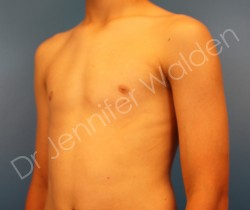 After Image: Male Breast Reduction - right-front-oblique