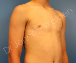 After Image: Male Breast Reduction - left-front-oblique