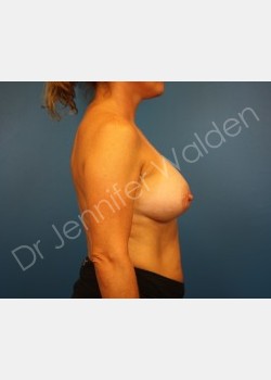 After Image: Silicone Breast Implants - right-side