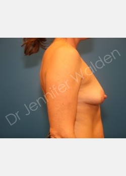 Before Image: Silicone Breast Implants - right-side