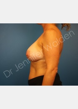 After Image: Silicone Breast Implants - left-side