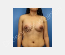 After Image: Breast Augmentation - front