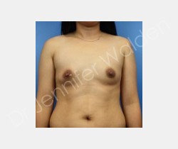 Before Image: Breast Augmentation - front