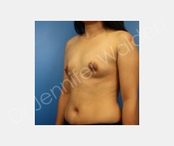 Before Image: Breast Augmentation - right-front-oblique