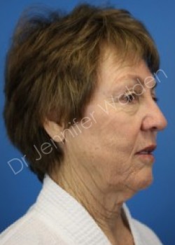 Venus Freeze before photo. Individual results may vary.