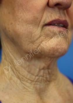 Venus Freeze after photo. Individual results may vary.