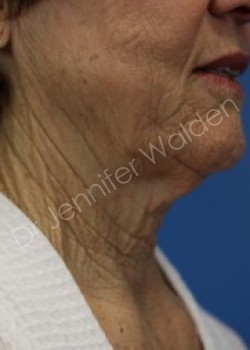 Venus Freeze before photo. Individual results may vary.