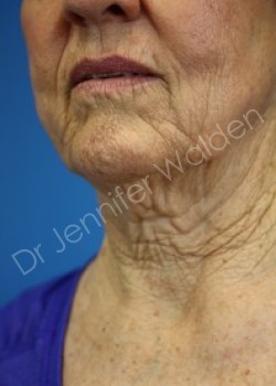 Venus Freeze after photo. Individual results may vary.