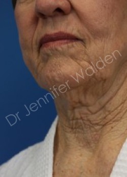 Venus Freeze before photo. Individual results may vary.