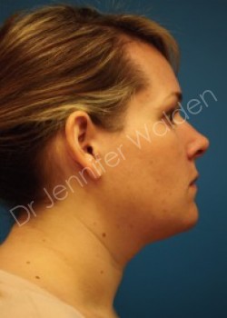 Venus Freeze before photo. Individual results may vary.